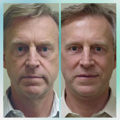 Facelift at Luna Clinic Turkey