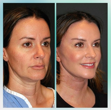 Facelift at Luna Clinic Turkey
