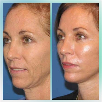 Facelift at Luna Clinic Turkey