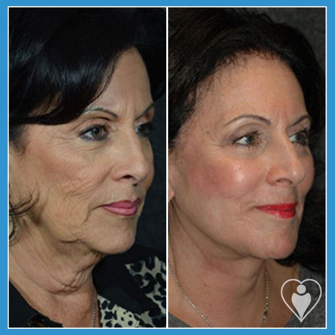 Facelift at Luna Clinic Turkey
