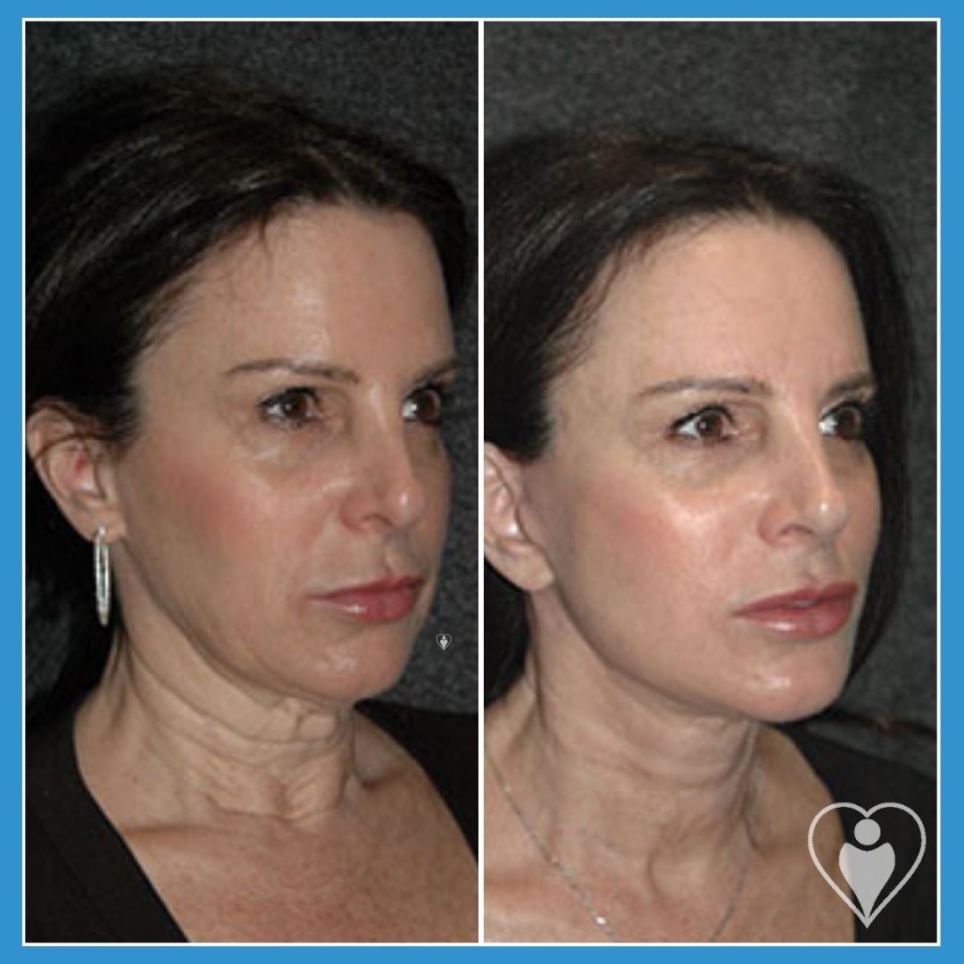 Facelift at Luna Clinic Turkey