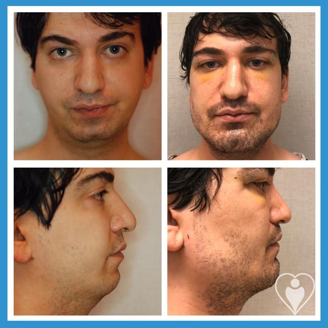 Facelift at Luna Clinic Turkey