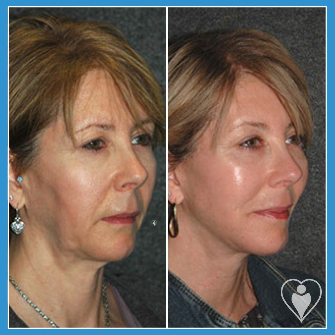 Facelift at Luna Clinic Turkey