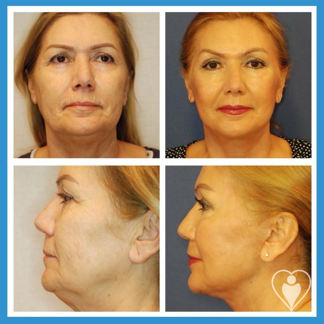 Facelift at Luna Clinic Turkey