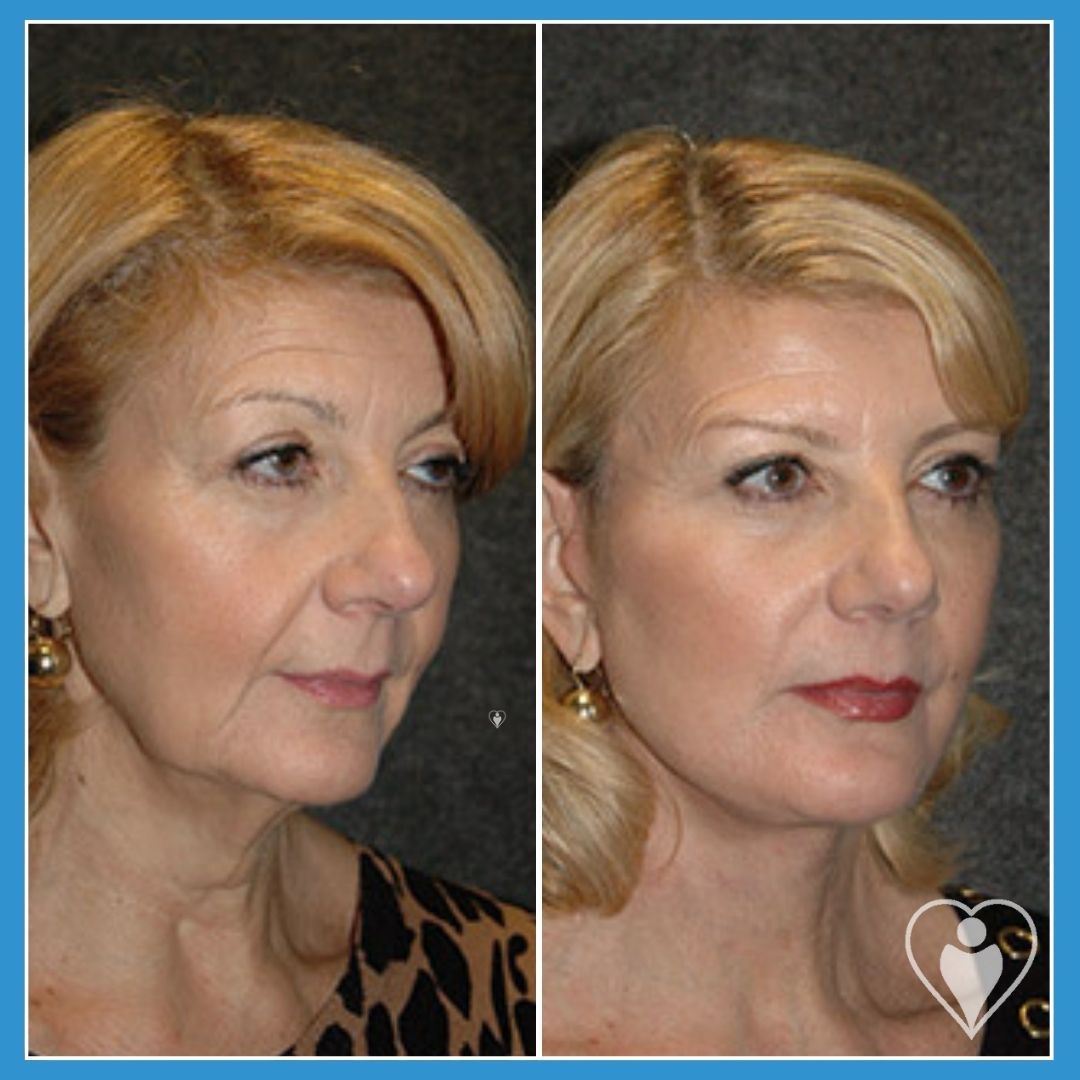 Facelift at Istanbul European Clinic