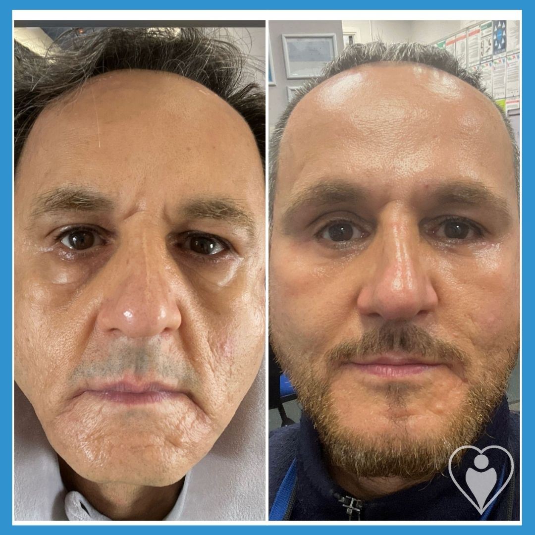 Facelift at Istanbul European Clinic