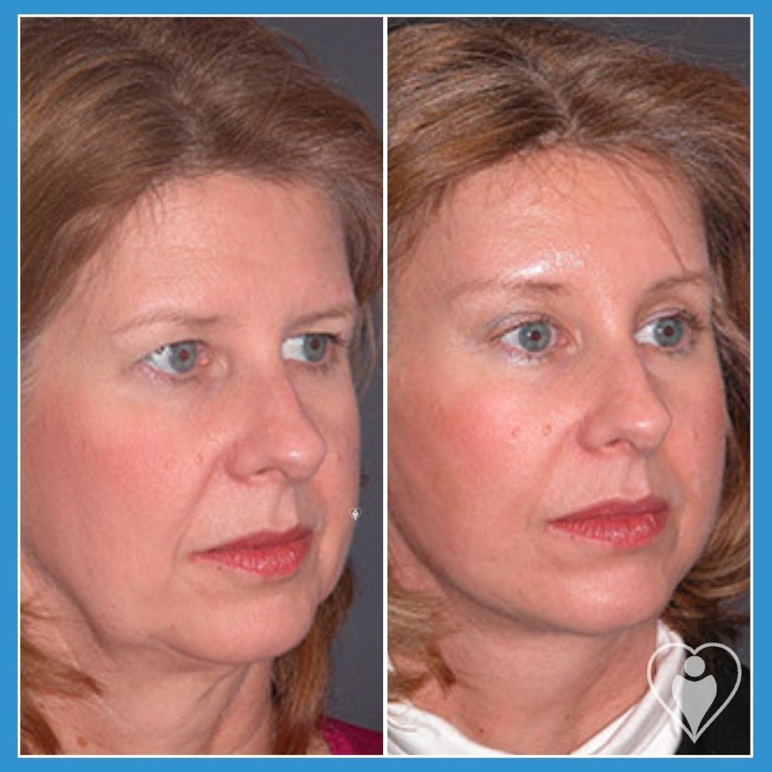 Facelift at Istanbul European Clinic