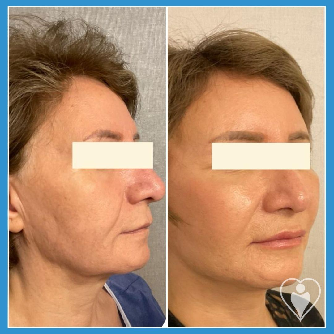 Facelift at Istanbul European Clinic