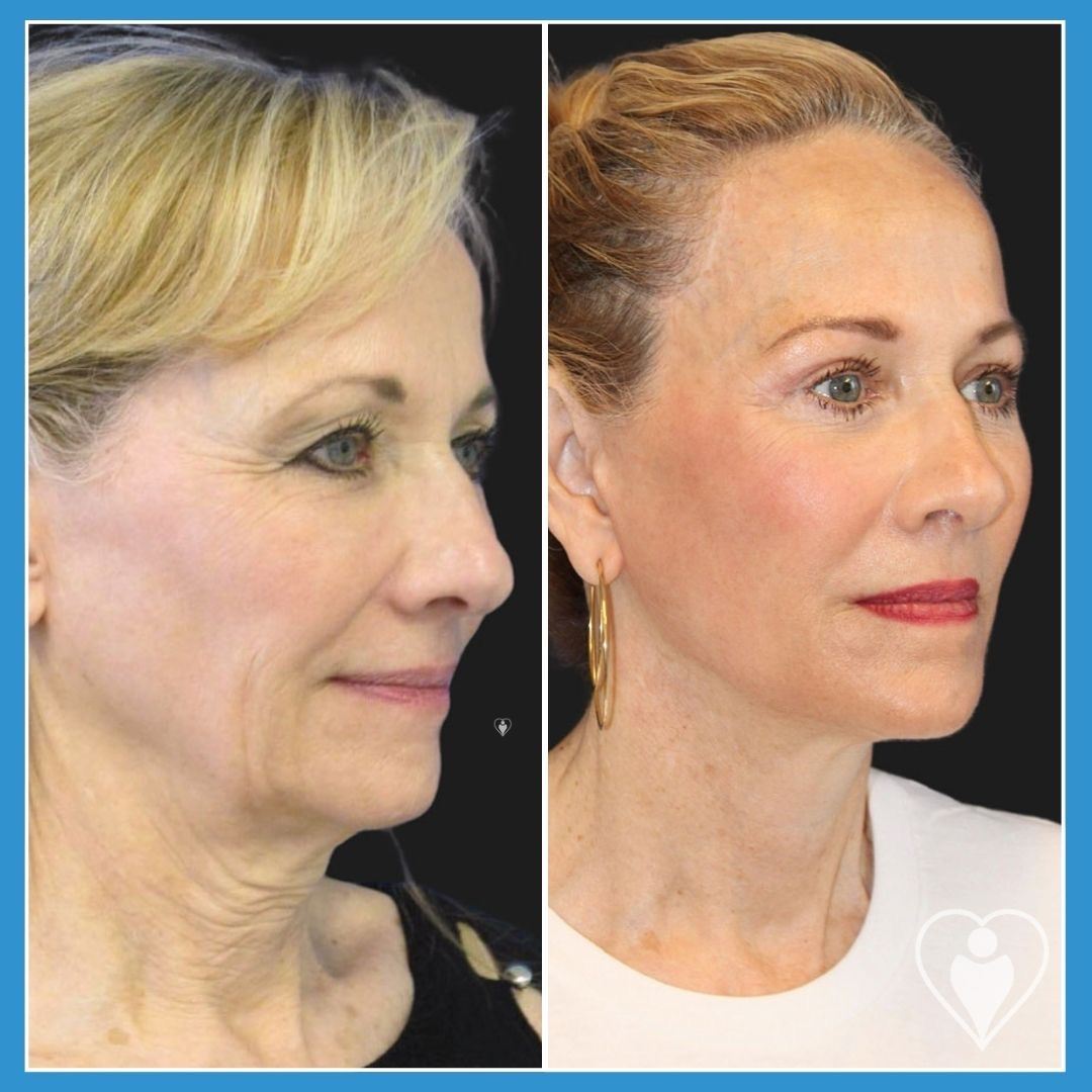 Facelift at Istanbul European Clinic