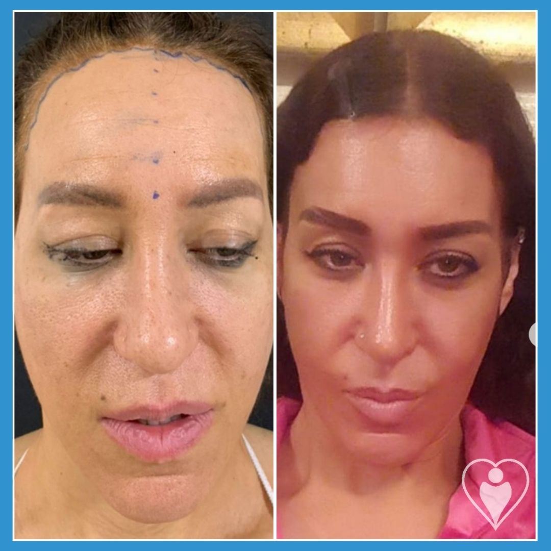 Facelift at Istanbul European Clinic