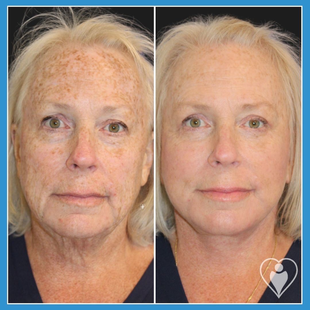 Facelift at Istanbul European Clinic