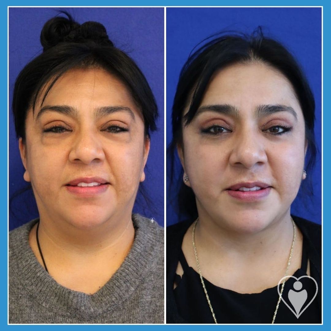 Facelift at Istanbul European Clinic