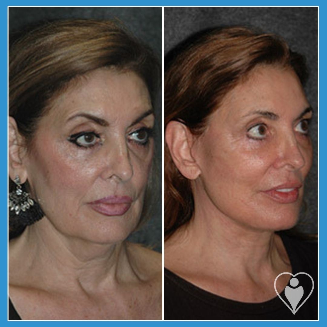 Facelift at Luna Clinic Turkey