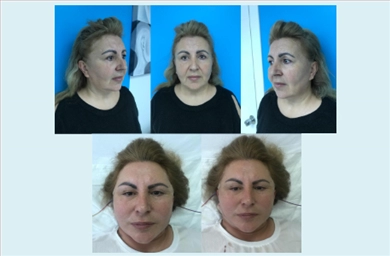 Facelift at Mediface Health Group