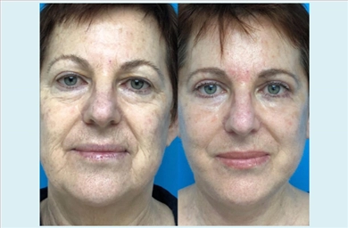 Facelift at Mediface Health Group