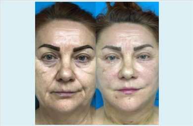 Facelift at Mediface Health Group