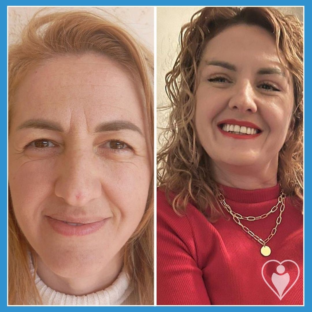 Facelift at Istanbul European Clinic