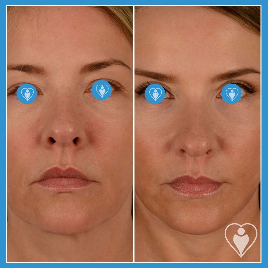 Facelift at Luna Clinic Turkey