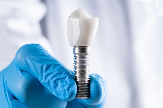 Cover image for Dental Bridge vs Implant: Which Is Right for You?